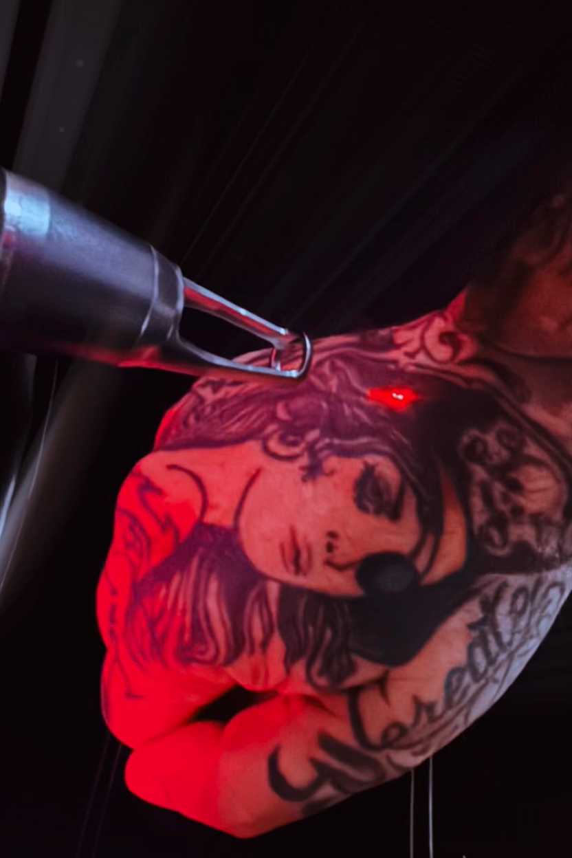 Pico YAG-laser voor het vervagen en verwijderen van tattoos